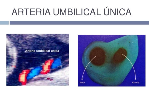 arteria umbilical unica